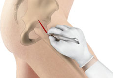 Minimally Invasive Total Hip Replacement – Direct Superior Approach