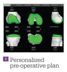 mako pre-op plan