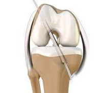 ACL Reconstruction (Patellar & Hamstring Tendon)