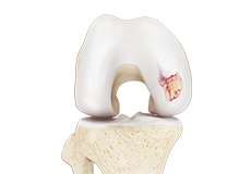 Osteoarthritis