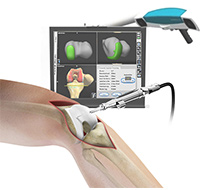 Computer Navigation for Total Knee Replacement