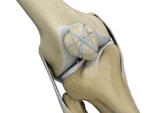 Knee Reconstruction