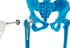 Robotic Assisted Hip Surgery