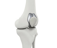 Patellofemoral Knee Replacement