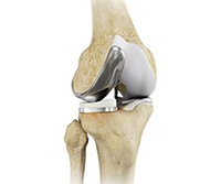 Unicompartmental Knee Replacement